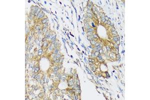 Immunohistochemistry of paraffin-embedded Human colon carcinoma using CLCC1 Rabbit pAb (ABIN7266333) at dilution of 1:100 (40x lens). (CLCC1 Antikörper  (AA 302-501))