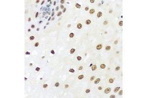 Immunohistochemical analysis of hnRNP A0 staining in human esophageal cancer formalin fixed paraffin embedded tissue section.