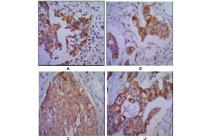 Immunohistochemical analysis of paraffin-embedded human lung cancer (A), colon cancer (B), ovarian cancer (C) and mammary cancer(D), using CDH2 antibody with DAB staining. (N-Cadherin Antikörper)