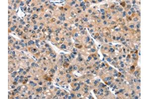 The image on the left is immunohistochemistry of paraffin-embedded Human liver cancer tissue using ABIN7190518(DUSP2 Antibody) at dilution 1/30, on the right is treated with synthetic peptide. (DUSP2 Antikörper)