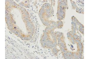 IHC-P Image Immunohistochemical analysis of paraffin-embedded human colon carcinoma, using PDYN, antibody at 1:250 dilution. (PDYN Antikörper)