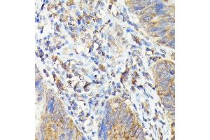 Immunohistochemistry of paraffin-embedded human colon carcinoma using T Rabbit pAb (ABIN3022236, ABIN3022237, ABIN3022238, ABIN1513586 and ABIN6218687) at dilution of 1:100 (40x lens). (TAP2 Antikörper  (AA 430-680))