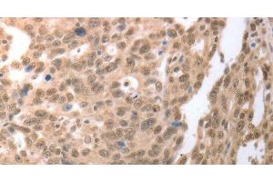 Immunohistochemistry of paraffin-embedded Human ovarian cancer tissue using RAD52 Polyclonal Antibody at dilution 1:50 (RAD52 Antikörper)