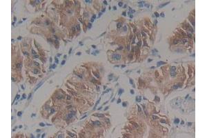DAB staining on IHC-P; Samples: Human Stomach cancer Tissue (HSD17B12 Antikörper  (AA 1-312))