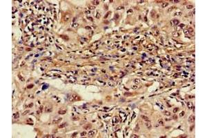 Immunohistochemistry of paraffin-embedded human lung cancer using ABIN7142600 at dilution of 1:100 (ALAS1 Antikörper  (AA 57-285))