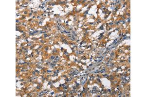 Immunohistochemistry of Human thyroid cancer using DDR2 Polyclonal Antibody at dilution of 1:40 (DDR2 Antikörper)