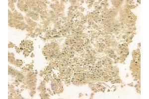 ABIN6263552 and ABIN6276984 at 1/100 staining human hepatocellular carcinoma by IHC-P. (Norrie Disease (Pseudoglioma) Antikörper  (Internal Region))