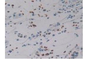 IHC-P analysis of Human Stomach Cancer Tissue, with DAB staining. (DEFA4 Antikörper  (AA 23-97))