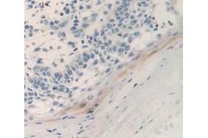 Used in DAB staining on fromalin fixed paraffin- embedded skin cancer tissue