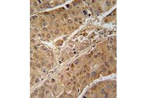 Immunohistochemical staining of formalin-fixed and paraffin-embedded human hepatocarcinoma reacted with RPS6KB2 monoclonal antibody  at 1:50-1:100 dilution. (RPS6KB2 Antikörper)