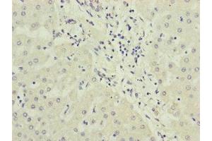 Immunohistochemistry of paraffin-embedded human liver cancer using ABIN7169283 at dilution of 1:100 (PPP2R3B Antikörper  (Regulatory Subunit B))