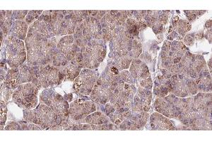 ABIN6273286 at 1/100 staining Human pancreas cancer tissue by IHC-P. (PAFAH2 Antikörper  (Internal Region))
