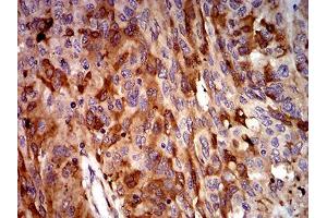 Immunohistochemical analysis of paraffin-embedded ovarian cancer tissues using C3C mouse mAb with DAB staining. (Complement C3c Antikörper  (AA 1521-1649))