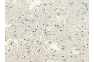 ABIN6261314 and ABIN6266687 at 1/100 staining human glioblastoma by IHC-P. (DLGAP1 Antikörper  (Internal Region))