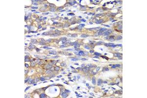 Immunohistochemistry of paraffin-embedded human gastric cancer using HAPLN1 antibody. (HAPLN1 Antikörper)