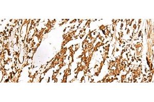 Immunohistochemistry of paraffin-embedded Human lung cancer tissue using TERF1 Polyclonal Antibody at dilution of 1:30(x200) (TRF1 Antikörper)