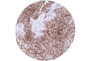 Lung Malignant mesothelioma with strong CD141 immunostaining of tumor cells CD141 immunohistochemistry. (Rekombinanter Thrombomodulin Antikörper  (AA 69-194))