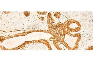 Immunohistochemistry of paraffin-embedded Human ovarian cancer tissue using KRT76 Polyclonal Antibody at dilution of 1:50(x200) (Cytokeratin 2 Antikörper)