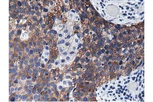 Immunohistochemical staining of paraffin-embedded Carcinoma of Human kidney tissue using anti-ALDH1L1 mouse monoclonal antibody. (ALDH1L1 Antikörper)