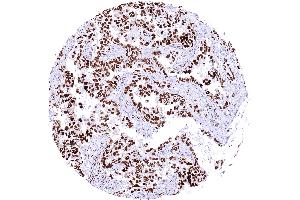 Pulmonary adenocarcinoma with strong PARP1 staining of tumor cells
