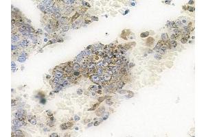 ABIN6261848 and ABIN6266490 at 1/100 staining human melanoma by IHC-P. (GAB2 Antikörper  (C-Term))