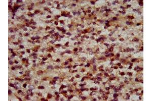 IHC image of ABIN7150380 diluted at 1:600 and staining in paraffin-embedded human glioma performed on a Leica BondTM system. (RFX2 Antikörper  (AA 1-130))
