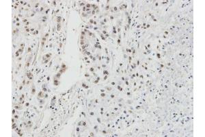 IHC-P Image Immunohistochemical analysis of paraffin-embedded A549 xenograft, using RPA32/RPA2, antibody at 1:100 dilution.