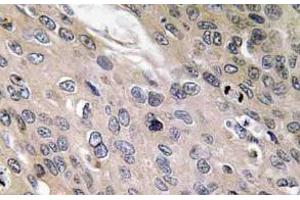Immunohistochemistry (IHC) analyzes of BMP-6 antibody in paraffin-embedded human lung carcinoma tissue. (BMP6 Antikörper)
