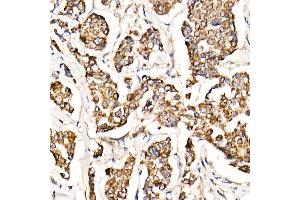 Immunohistochemistry of paraffin-embedded human breast cancer using [KO Validated] MyD88 Rabbit mAb (ABIN7268723) at dilution of 1:1000 (40x lens). (MYD88 Antikörper)