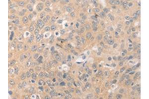 The image on the left is immunohistochemistry of paraffin-embedded Human ovarian cancer tissue using ABIN7189978(BEST1 Antibody) at dilution 1/20, on the right is treated with synthetic peptide. (Bestrophin 1 Antikörper)