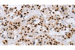 Immunohistochemistry of paraffin-embedded Human thyroid cancer using IL17C Polyclonal Antibody at dilution of 1:50 (IL17C Antikörper)