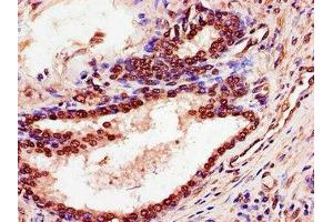 Immunohistochemistry of paraffin-embedded human prostate cancer using ABIN7168587 at dilution of 1:100 (SPDEF/PSE Antikörper  (AA 145-247))