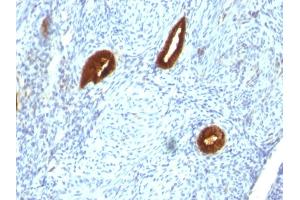 Formalin-fixed, paraffin-embedded human Endometrial Carcinoma stained with Cytokeratin 19 Mouse Monoclonal Antibody (SPM266). (Cytokeratin 19 Antikörper)
