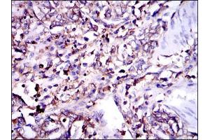 Immunohistochemical analysis of paraffin-embedded stomach cancer tissues using G6PD mouse mAb with DAB staining. (Glucose-6-Phosphate Dehydrogenase Antikörper)