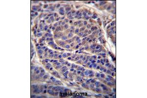 CA6 Antibody (C-term) (ABIN656592 and ABIN2845853) immunohistochemistry analysis in formalin fixed and paraffin embedded human melanoma followed by peroxidase conjugation of the secondary antibody and DAB staining. (CA6 Antikörper  (C-Term))
