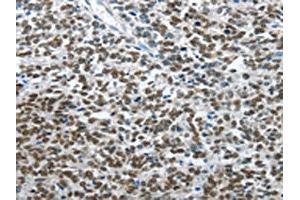 The image on the left is immunohistochemistry of paraffin-embedded Human ovarian cancer tissue using ABIN7128510(ARL2 Antibody) at dilution 1/15, on the right is treated with fusion protein. (ARL2 Antikörper)