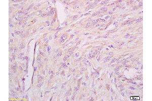 Formalin-fixed and paraffin embedded human cervical carcinoma tissue labeled with Anti phospho-IFNAR1(Ser535+Ser539) Polyclonal Antibody,Unconjugated (ABIN802353) at 1:200 followed by conjugation to the secondary antibody and DAB staining. (IFNAR1 Antikörper  (pSer535, pSer538))