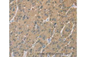 Immunohistochemistry of Human gastric cancer using CYP2C9 Polyclonal Antibody at dilution of 1:50 (CYP2C9 Antikörper)