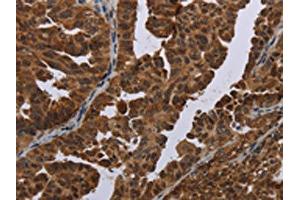 The image on the left is immunohistochemistry of paraffin-embedded Human ovarian cancer tissue using ABIN7191351(MAGEB3 Antibody) at dilution 1/20, on the right is treated with synthetic peptide. (MAGEB3 Antikörper)