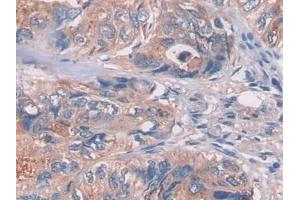 DAB staining on IHC-P; Samples: Human Colorectal cancer Tissue (LGALS3BP Antikörper  (AA 24-221))