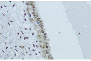 Immunohistochemistry of paraffin-embedded Human mammary cancer using NR1I3 Polyclonal Antibody at dilution of 1:200 (40x lens). (NR1I3 Antikörper)