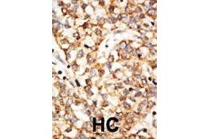 Formalin-fixed and paraffin-embedded human cancer tissue reacted with the primary antibody, which was peroxidase-conjugated to the secondary antibody, followed by DAB staining. (APOBEC1 Antikörper  (N-Term))