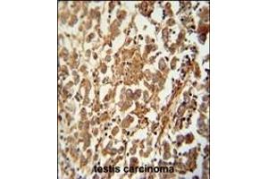 STC1 antibody (N-term) (ABIN654579 and ABIN2844281) immunohistochemistry analysis in formalin fixed and raffin embedded human testis carcinoma followed by peroxidase conjugation of the secondary antibody and DAB staining. (SPATC1 Antikörper  (N-Term))