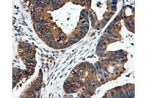 Immunohistochemical staining of paraffin-embedded Adenocarcinoma of colon tissue using anti-FAHD2Amouse monoclonal antibody. (FAHD2A Antikörper)