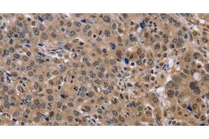 Immunohistochemistry of paraffin-embedded Human liver cancer tissue using KIF25 Polyclonal Antibody at dilution 1:40 (KIF25 Antikörper)