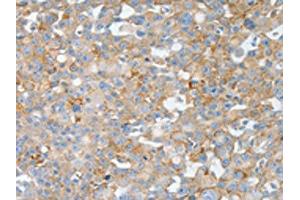 The image on the left is immunohistochemistry of paraffin-embedded Human breast cancer tissue using ABIN7190004(BPIFB2 Antibody) at dilution 1/50, on the right is treated with synthetic peptide. (BPIL1 Antikörper)