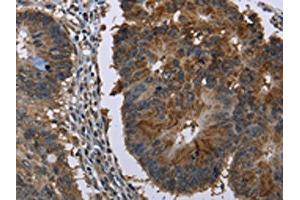 The image on the left is immunohistochemistry of paraffin-embedded Human colon cancer tissue using ABIN7129746(HSD17B6 Antibody) at dilution 1/20, on the right is treated with fusion protein. (HSD17B6 Antikörper)