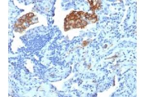 IHC testing of FFPE human lung carcinoma with DC-SIGN antibody (clone C209/1781). (DC-SIGN/CD209 Antikörper)