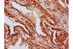 IHC image of ABIN7156973 diluted at 1:400 and staining in paraffin-embedded human prostate cancer performed on a Leica BondTM system. (IFT172 Antikörper  (AA 1368-1502))