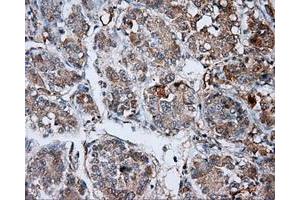 Immunohistochemical staining of paraffin-embedded Carcinoma of liver tissue using anti-LIPG mouse monoclonal antibody. (LIPG Antikörper)